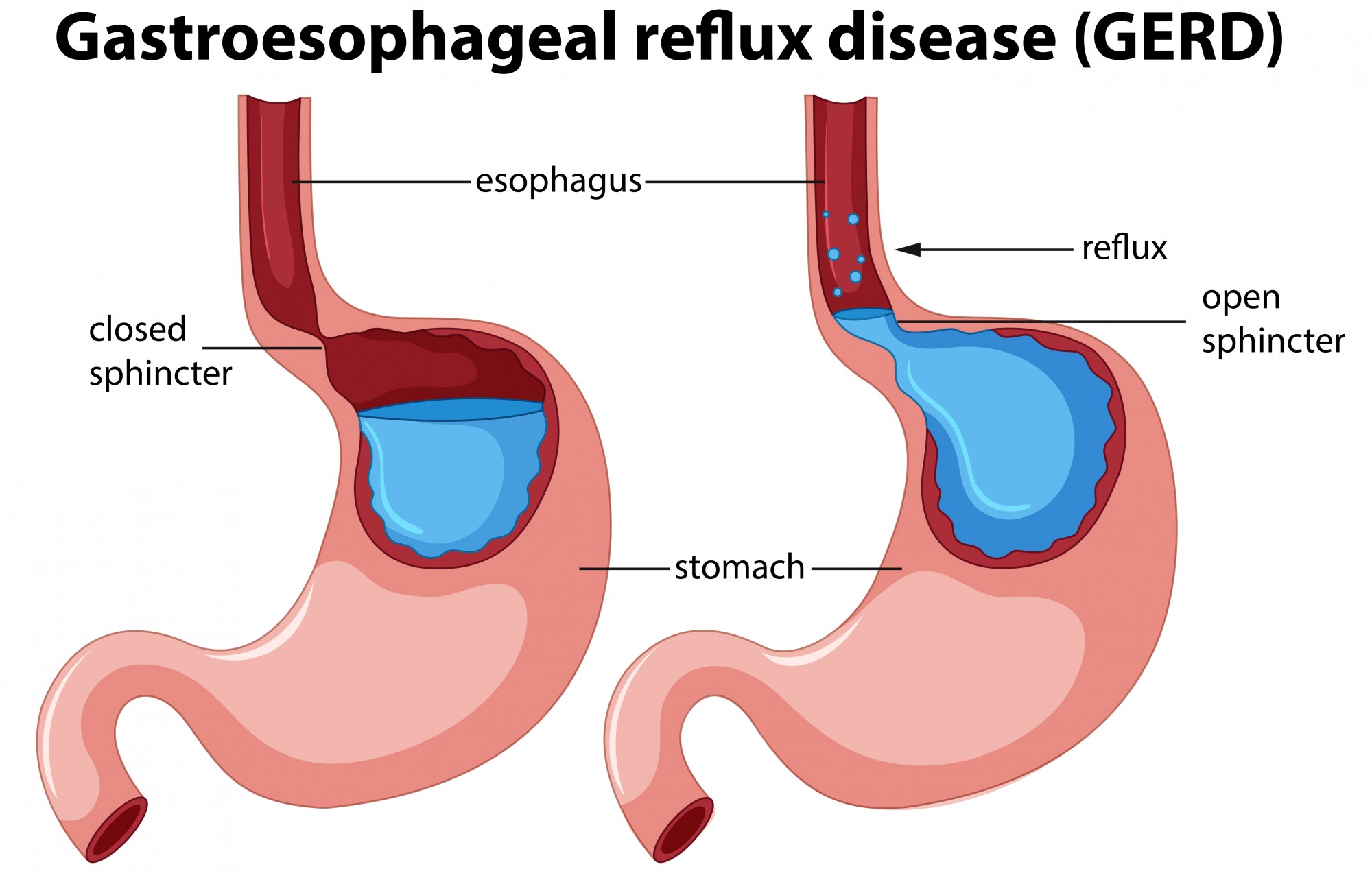Image of GERD affecting the stomach 